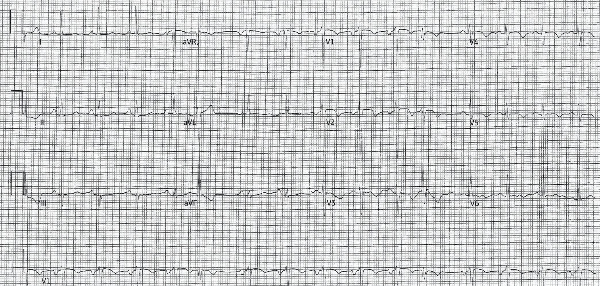 EKG strip from a patient experiencing an acute coronary syndrome.