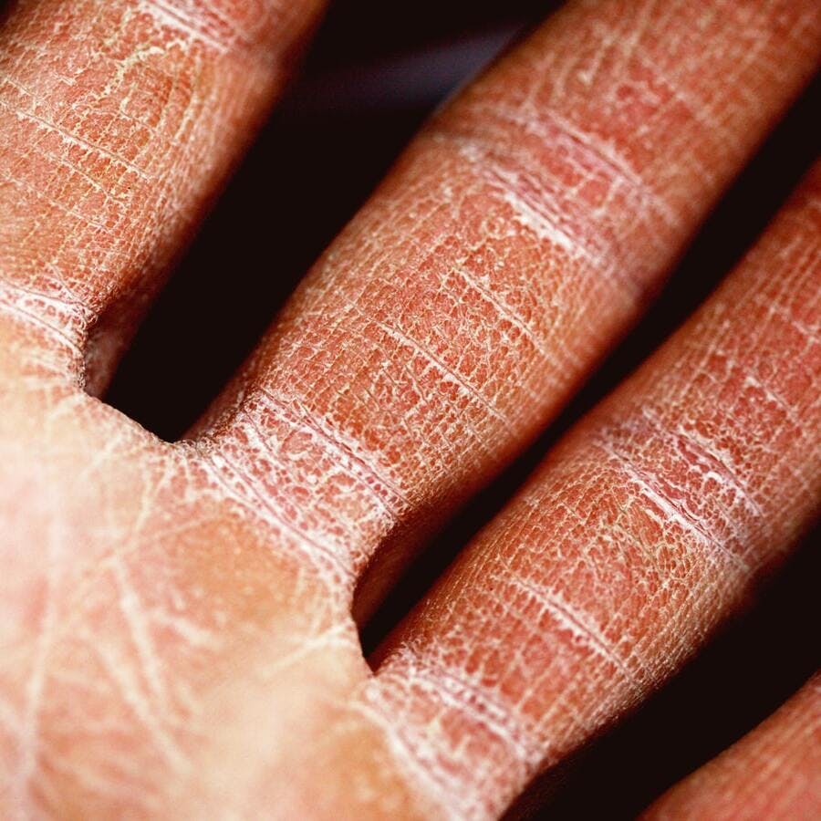 Atopic Dermatitis Severity Linked to Incremental Societal Healthcare Costs