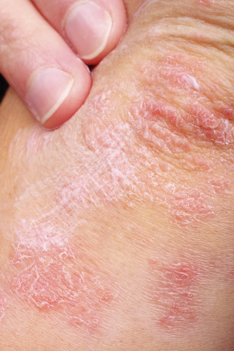 Therapy for Difficult-to-Treat Skin Disease Now Available in Japan