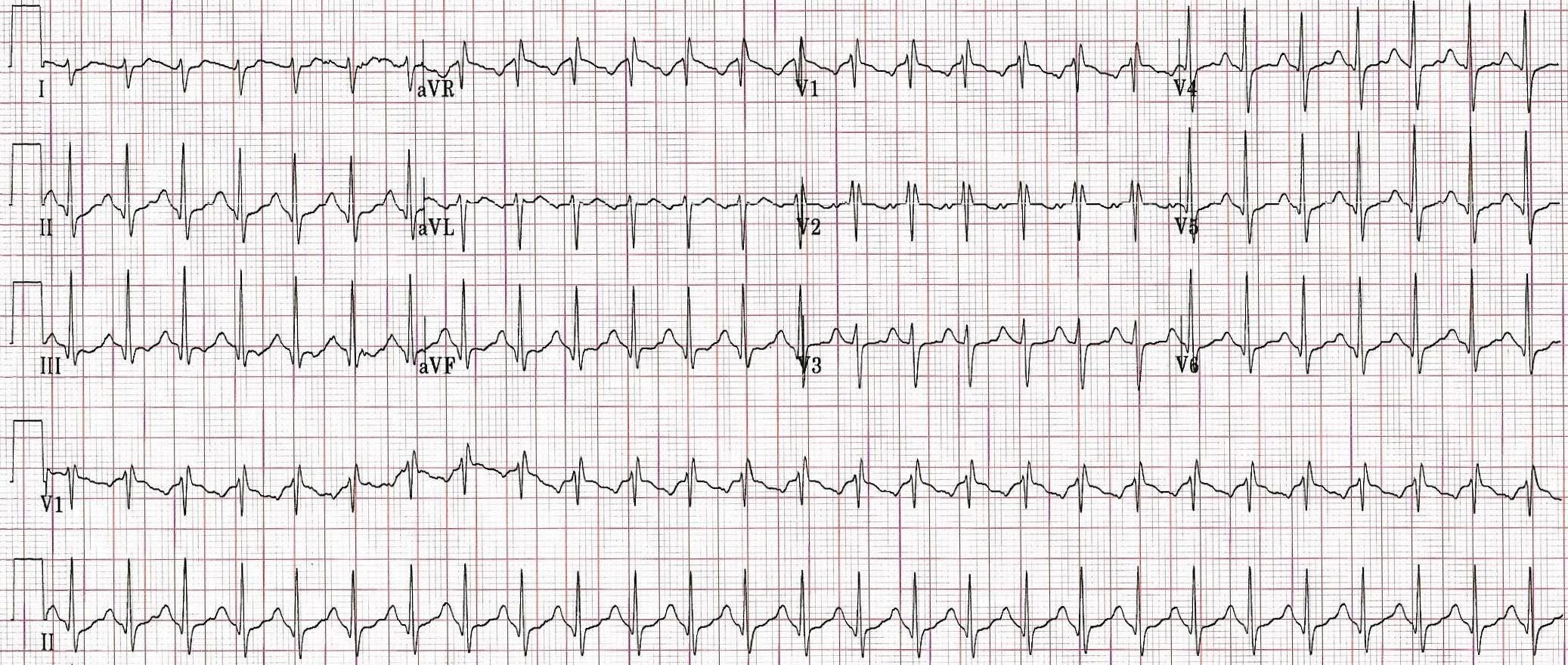 EKG of a patient presenting with overdose