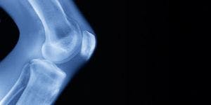 Symptomatic Knee Osteoarthritis Has Increased Greatly