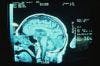 Improving Awareness of Hypopituitarism in Traumatic Brain Injury