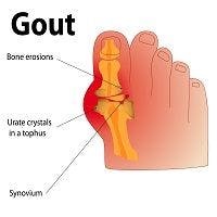 People with Gout Not As Likely to Develop Alzheimer's Disease