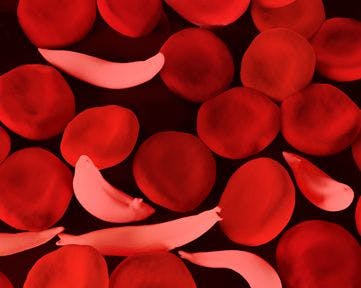 Study Finds Hydroxyurea Dose Escalation Lowers Stroke Risk in Children with Sickle Cell Anemia