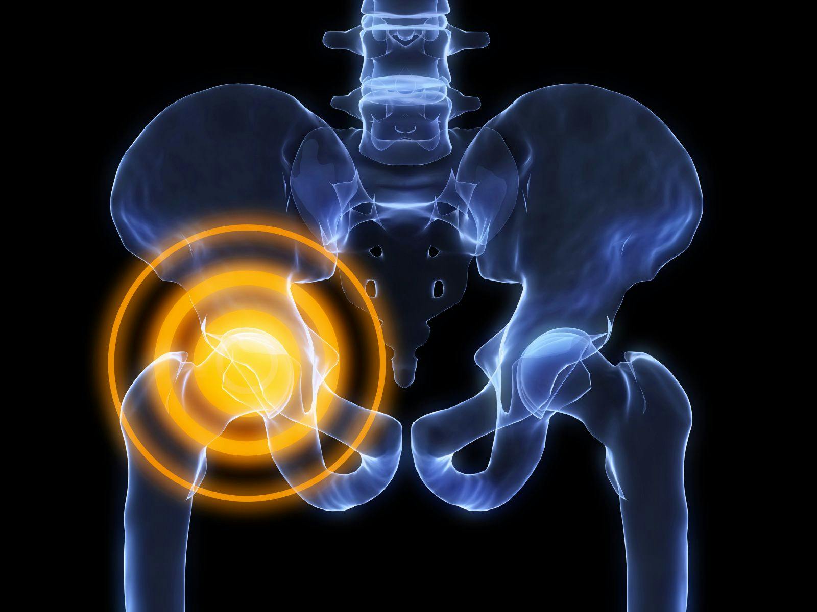 Osteoporosis Therapy Could Cut Need for Revision Procedures Following Hip Replacements