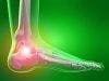Ankle Replacement Provides Relief for Patients with Arthritis