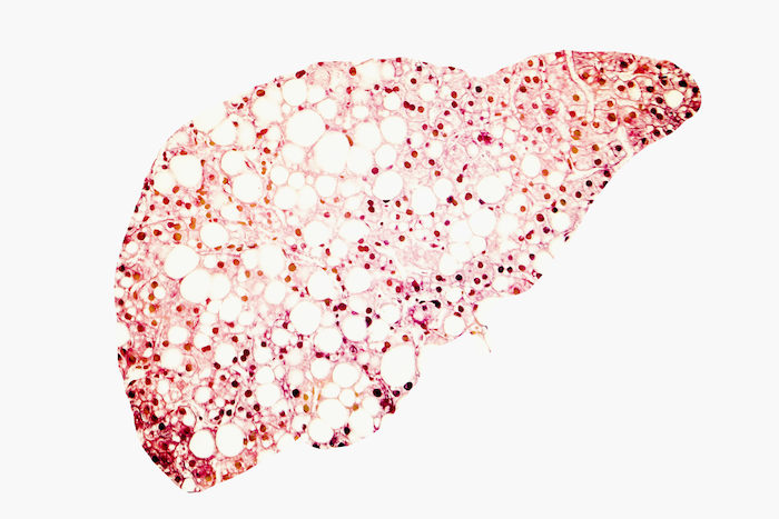 Severe Hepatic Steatosis and Thrombocytopenia Increase Risk of All-Cause, Cardiovascular-Related Mortality
