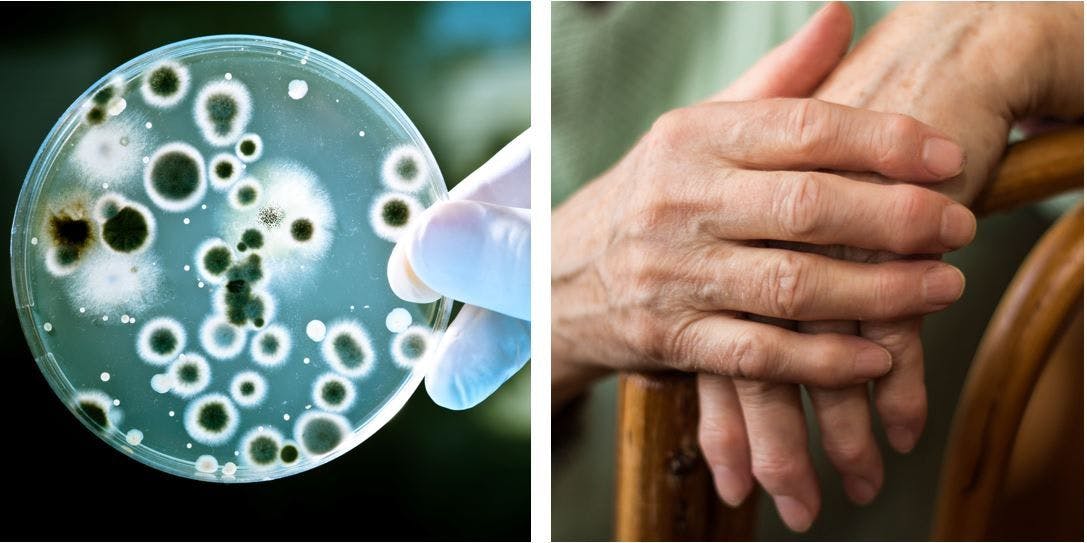 Glucocorticoids and Biologics Share Similar Infection Risk in Rheumatoid Arthritis