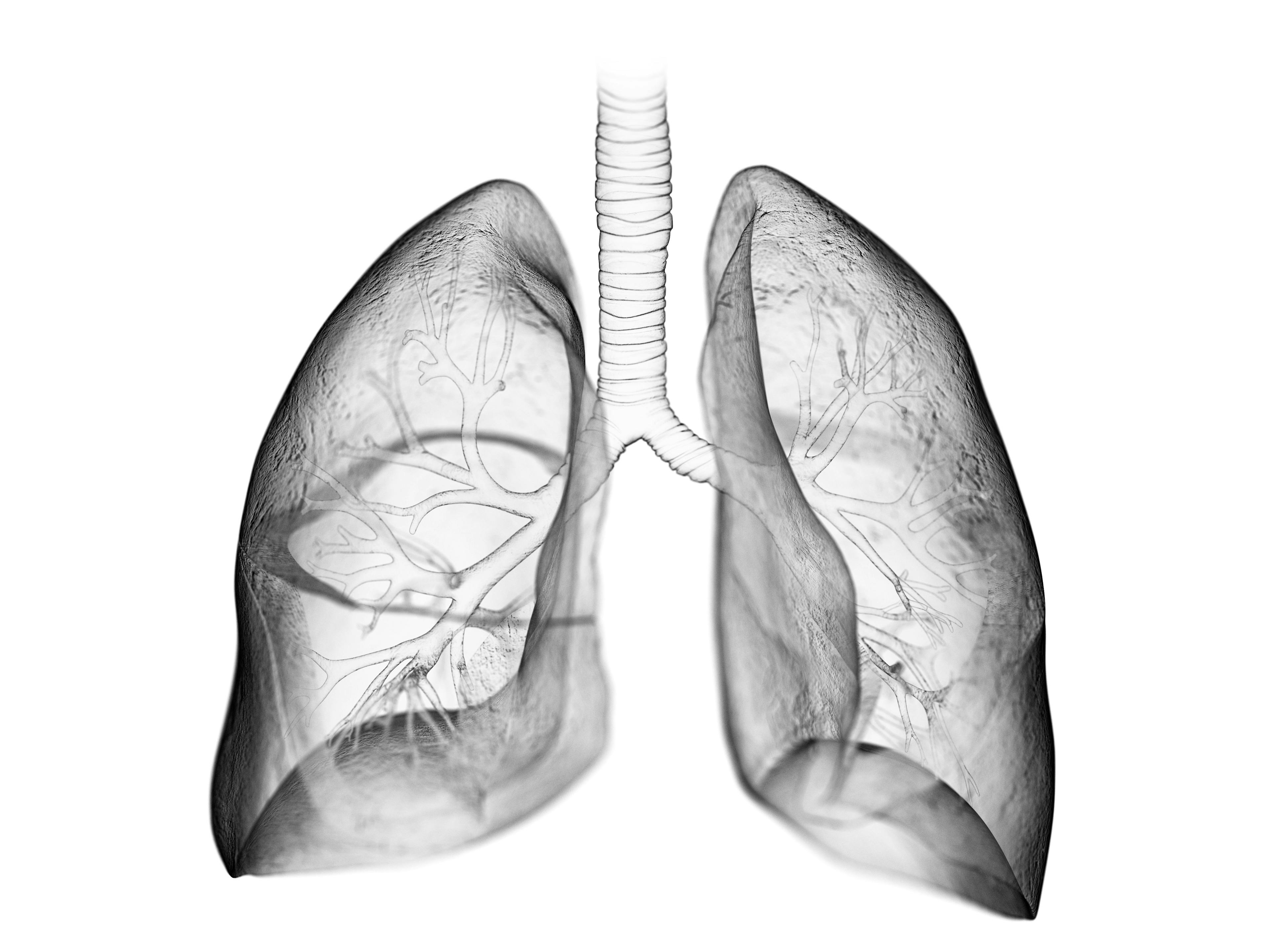 Ninfetanib Improves and Stabilizes Lung Function in Systemic Sclerosis