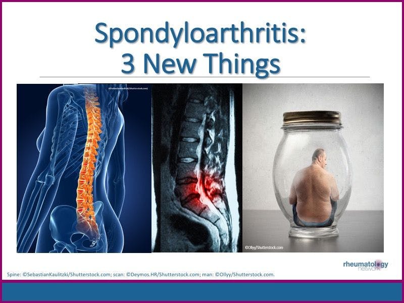 Spondyloarthritis: 3 New Things