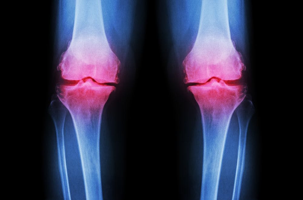 Knee Osteoarthritis:  Treatment Practice and Treatment Guidelines Not in Synch