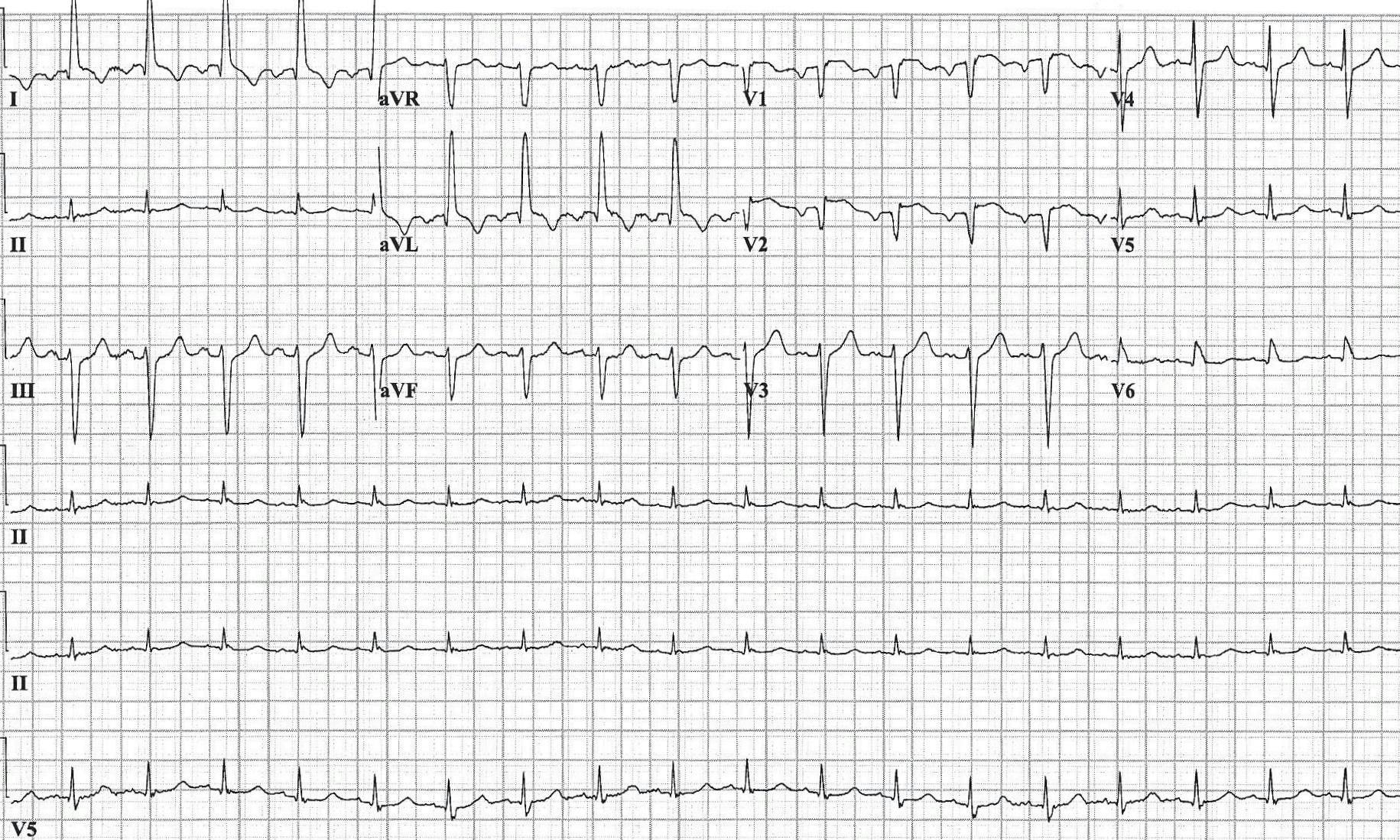 An ECG readout of a patient with nonpleuritic chest pain