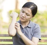Investigators Assess Eczema Control, Itch Intensity Tools