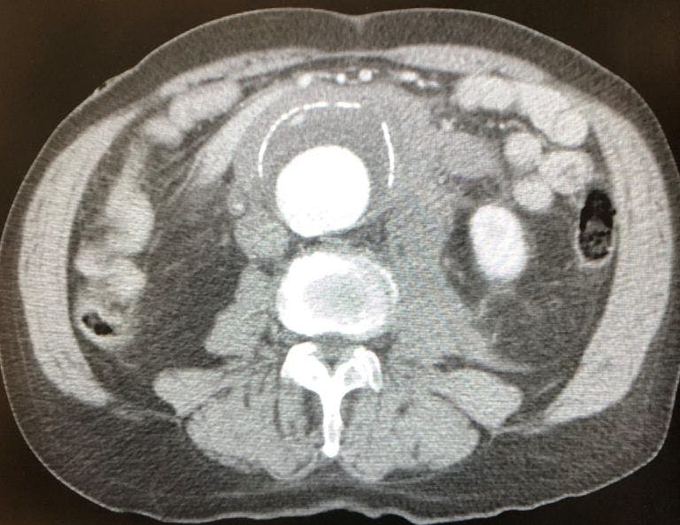 CT Scan of a patient's abdomen | Credit: Brady Pregerson, MD
