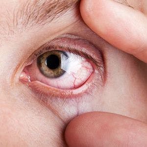 Cyclosporine Ophthalmic Solution Shows Consistent Therapeutic Effect for Dry Eye Disease