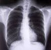 Novel COPD Therapy Daliresp Receives FDA Approval